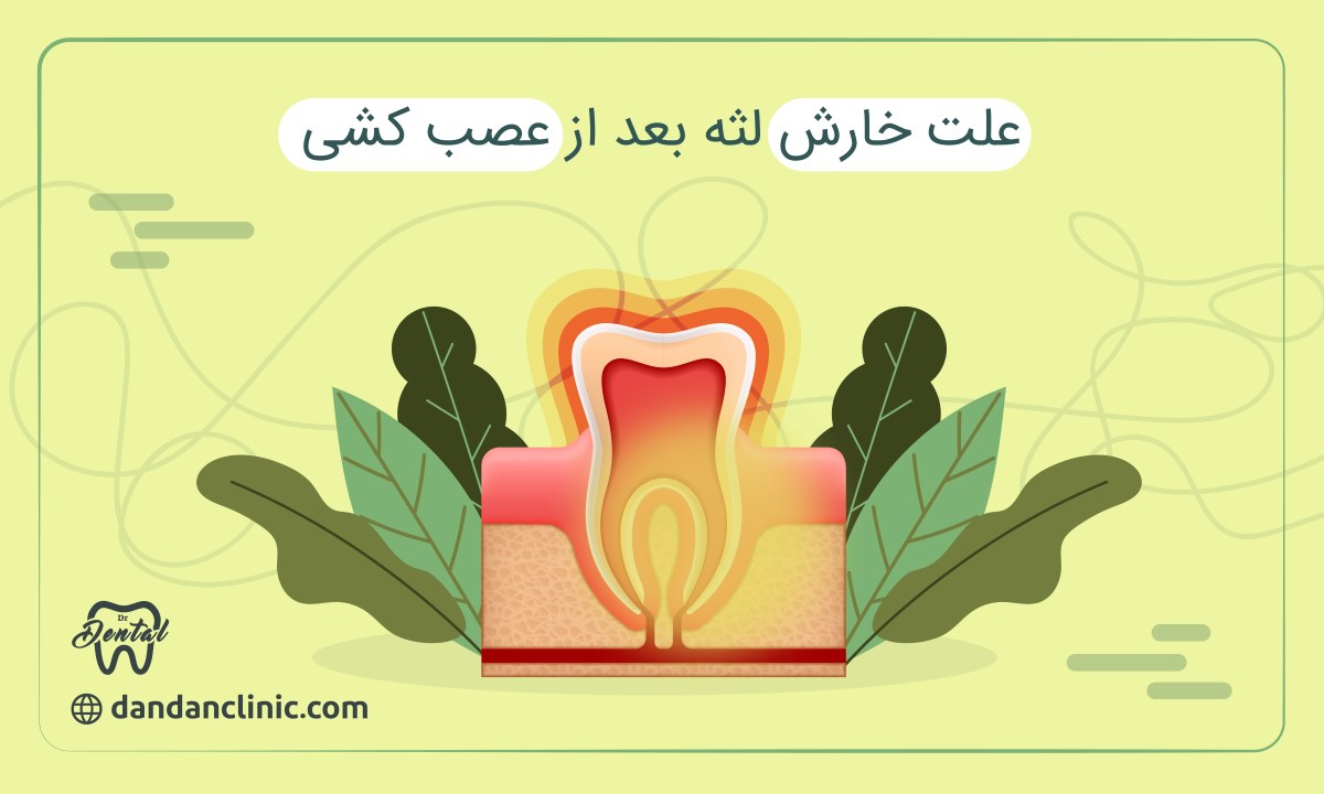 علت خارش لثه بعد از عصب کشی