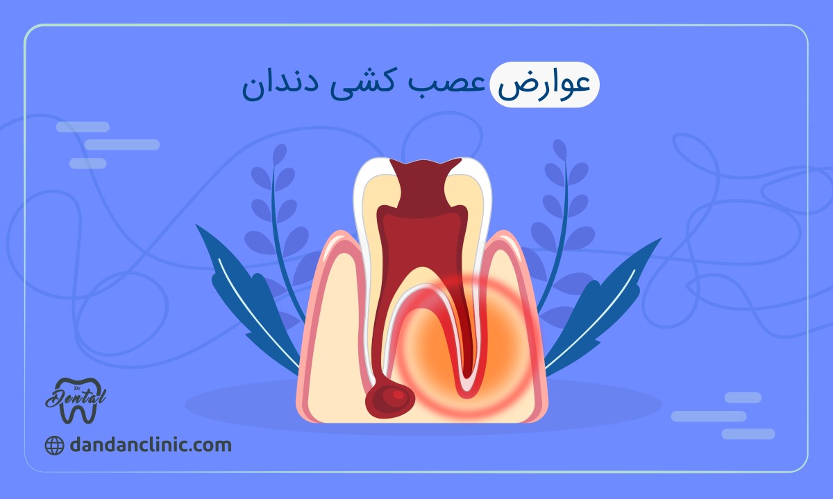 عوارض عصب کشی دندان