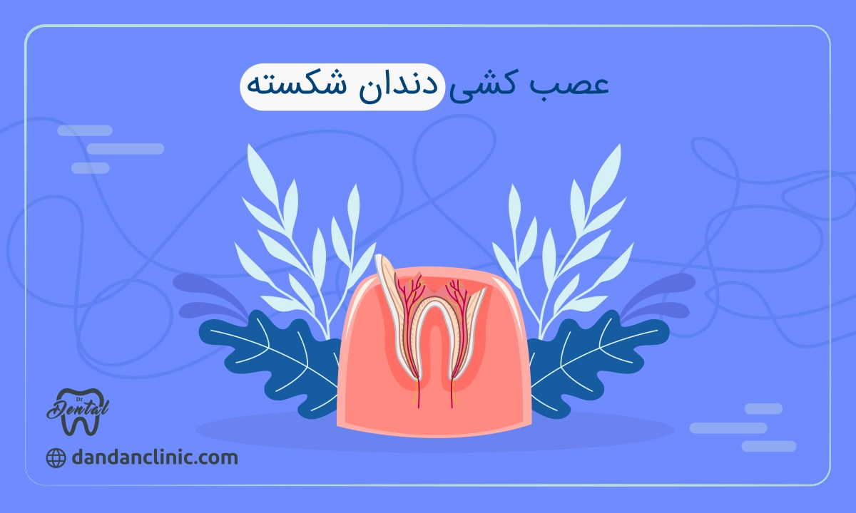 عصب کشی دندان شکسته 