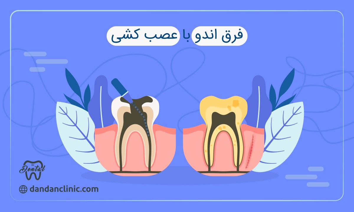 فرق اندو با عصب کشی 