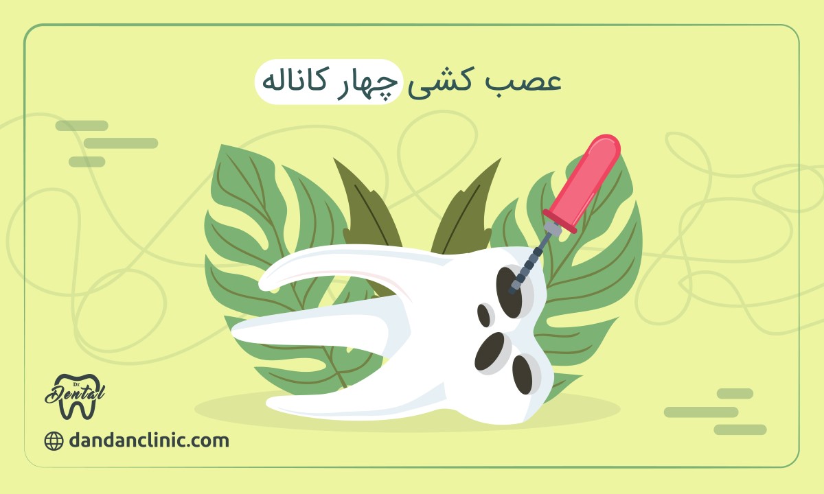 عصب کشی چهار کاناله
