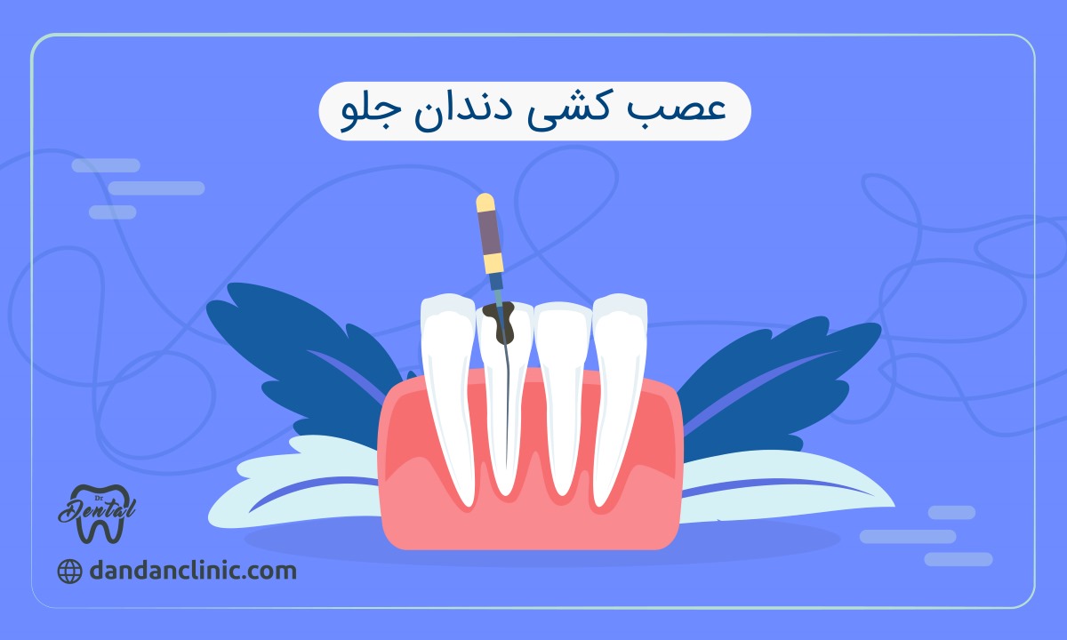 عصب کشی دندان جلو