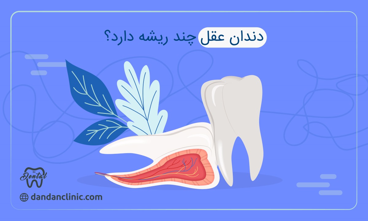 دندان عقل چند ریشه دارد