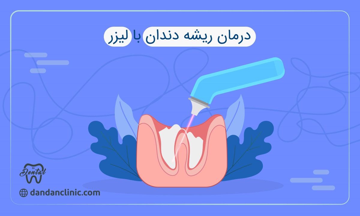درمان ریشه دندان با لیزر
