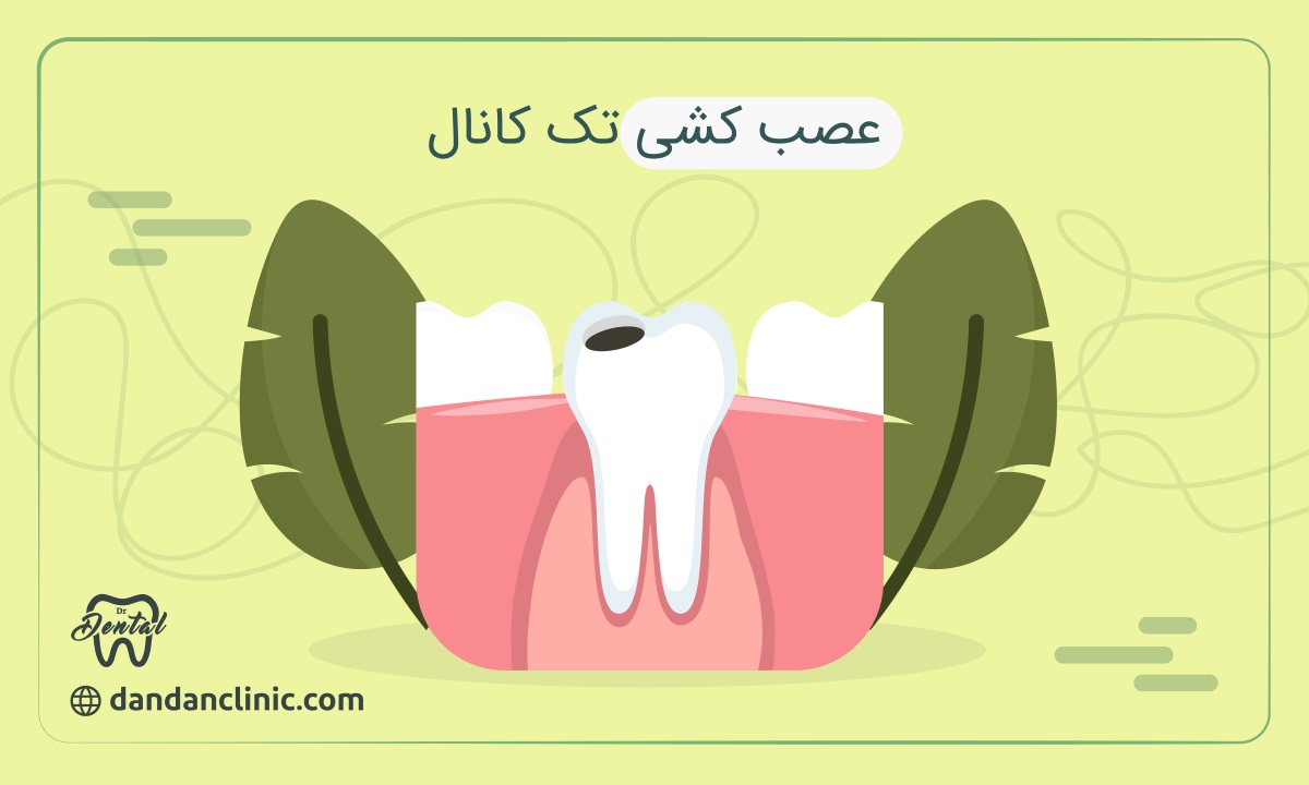 عصب كشي تك كانال