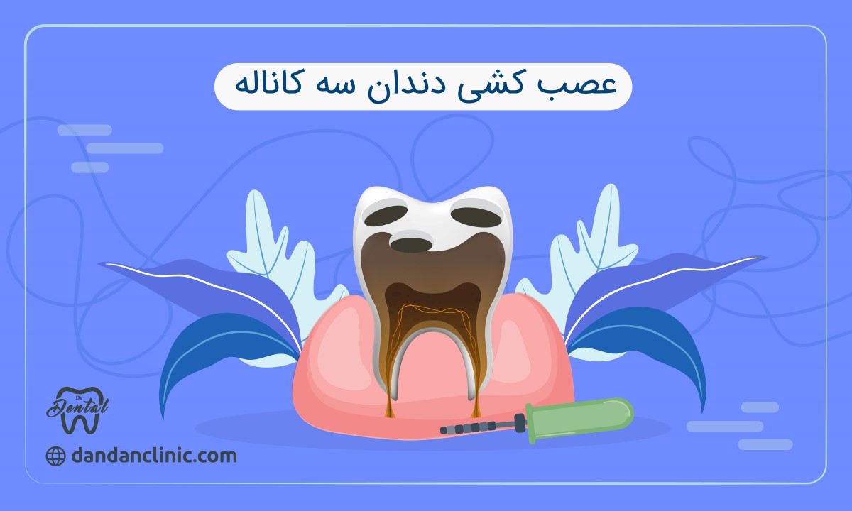 عصب کشی دندان سه کاناله 