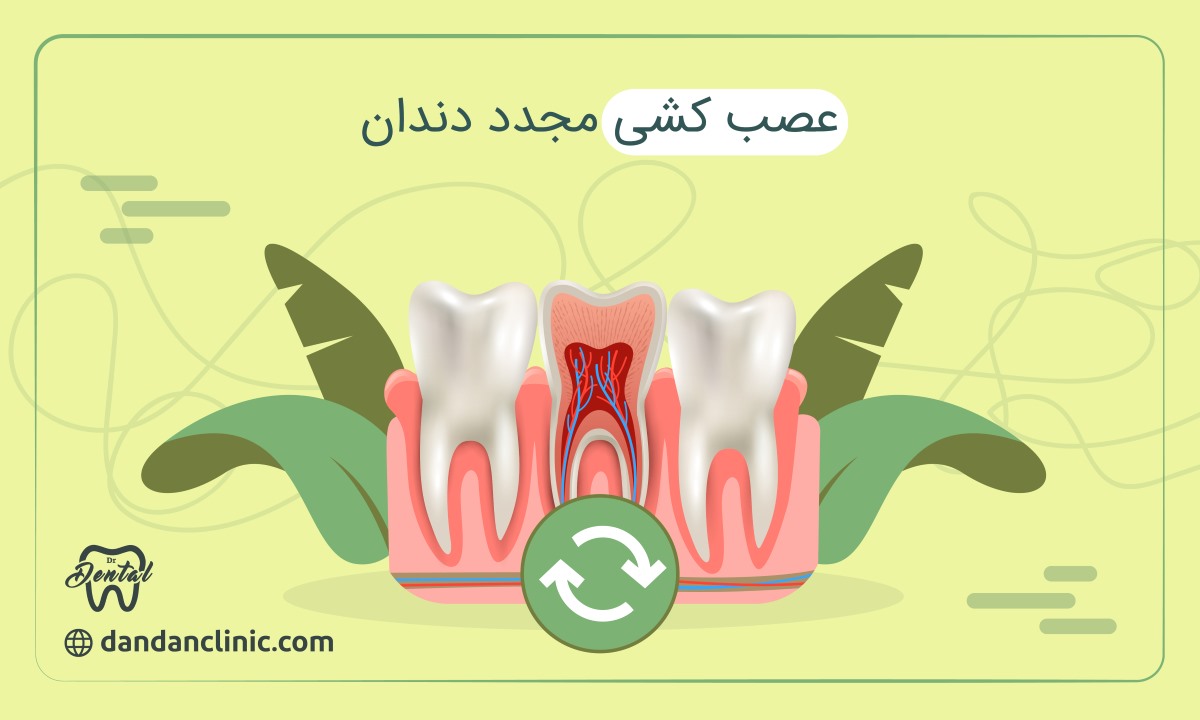 عصب کشی مجدد دندان