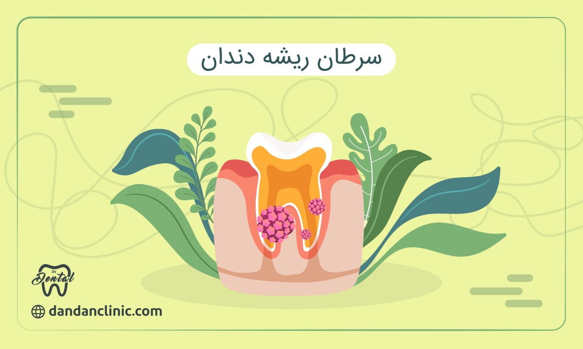 سرطان ریشه دندان