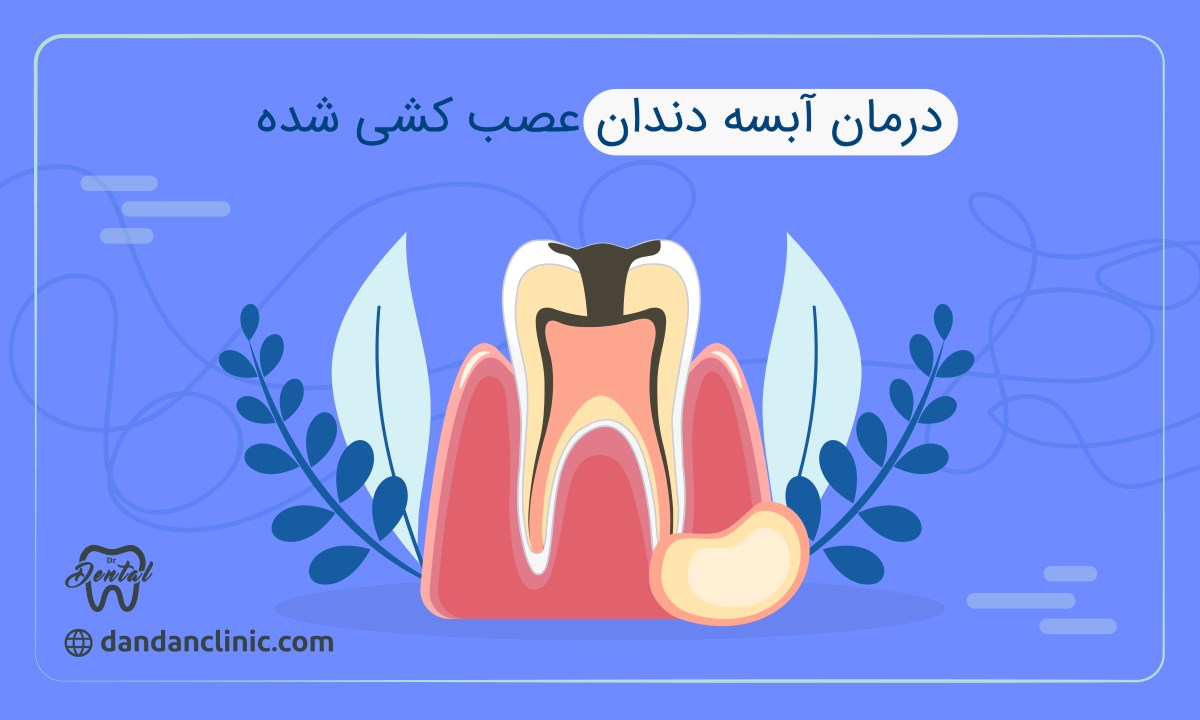 درمان آبسه دندان عصب کشی شده 
