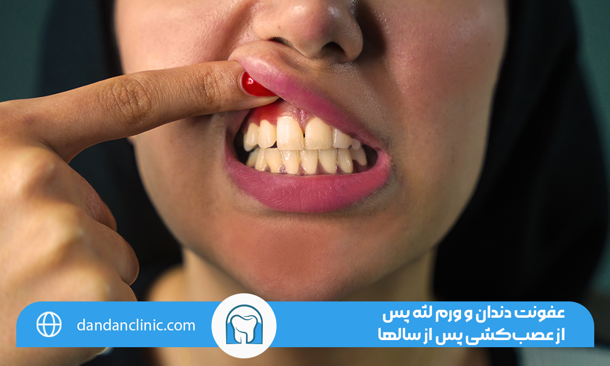 درمان ورم لثه بعد از عصب کشی