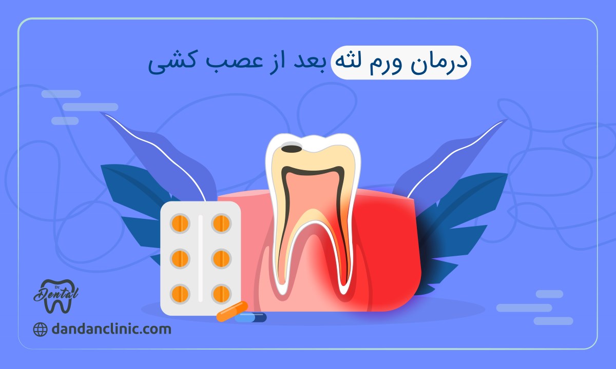 درمان ورم لثه بعد از عصب کشی