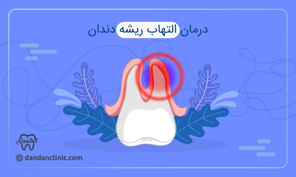 درمان التهاب ریشه دندان