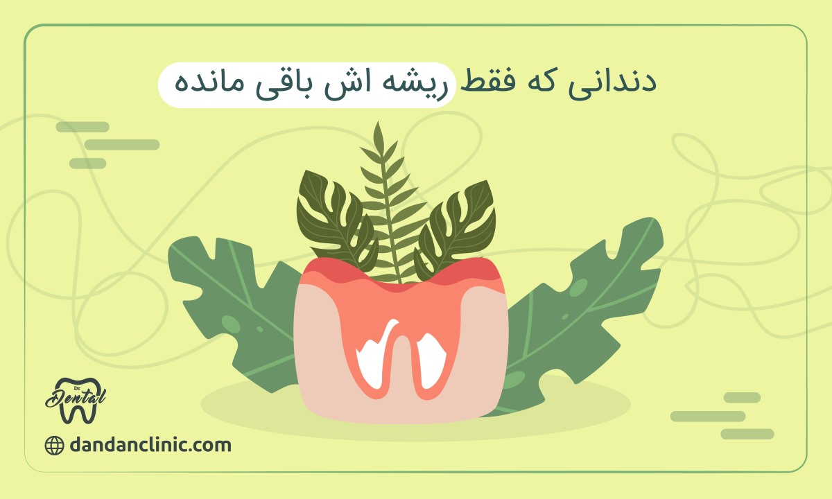 دندانی که فقط ریشهاش باقی مانده