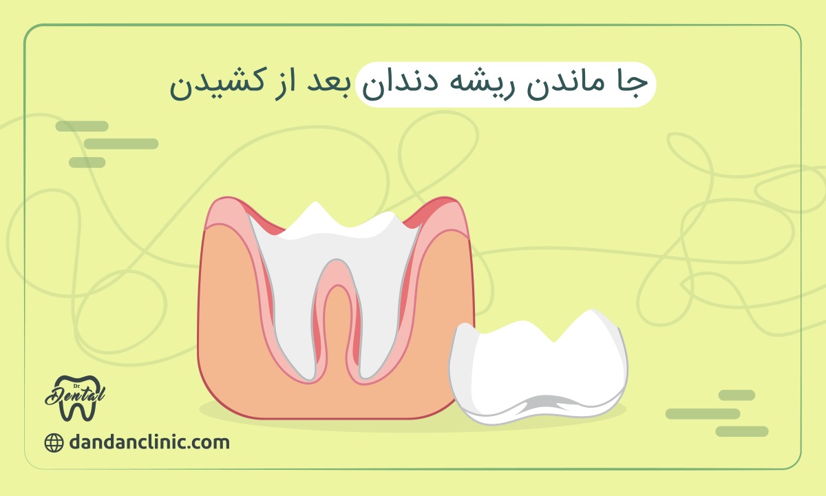 جا ماندن ریشه دندان بعد از کشیدن 